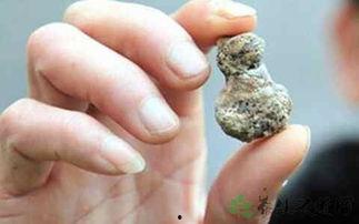 肾结石可以吃洋瓜吃,洋瓜助力健康排石